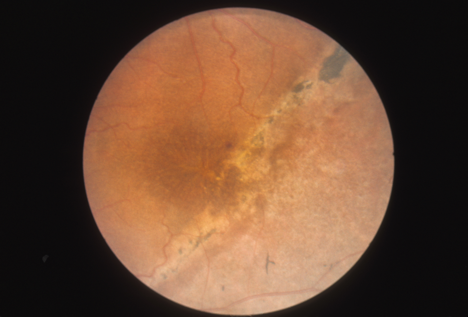 Retinoschisis, Juvenile Hereditary Ocular Diseases